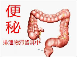 何謂便秘